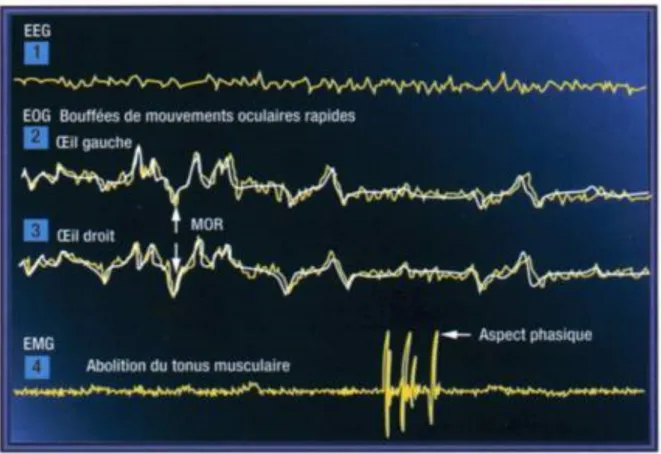 Figure 5 : Présentation de l’EEG, L’EOG et L’EMG du stade 5 ou REM (7)