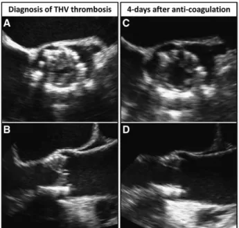 Figure 4. Serial computed tomographic (CT) images  showing the effect of oral anticoagulation on chronic  valve thrombosis