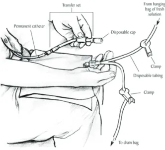 Figure 9 : Système à double poche (source : site niddk.nih.gov) 