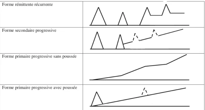 Figure 4 Formes évolutives de SEP. Source : La sclérose en plaques - historique,  épidémiologie et pathogénie par Gilles Defer, Marc  Debouverie