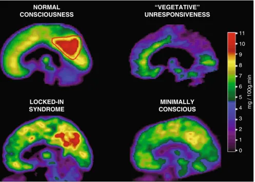 Fig. 9 In normal conscious waking, the medial posterior cortex (encompassing the precuneus and adjacent posterior cingulate cortex, delineated by a red line) is the metabolically most active region of the brain; in waking “ vegetative ” /unresponsive patie