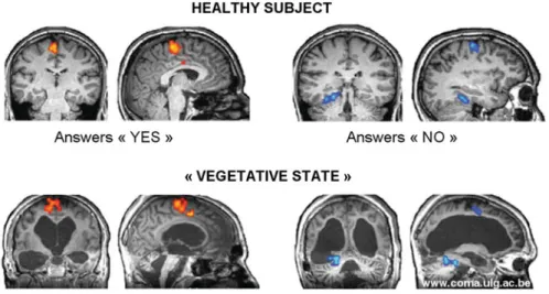 Fig. 10 Reliable fMRI-based communication in severely brain-damaged patients unable to show any motor-pathway-dependent communication