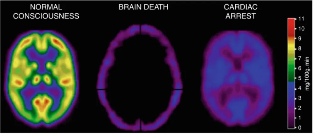 Fig. 5 Positron emission tomography (PET) scans illustrating the “empty skull sign” in brain death and massive global decrease of brain metabolism in a cardiac arrest survivor