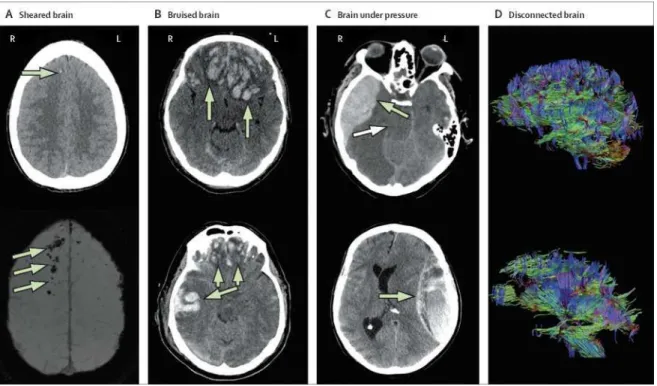 Figure 1: The multiple faces of traumatic brain injury 