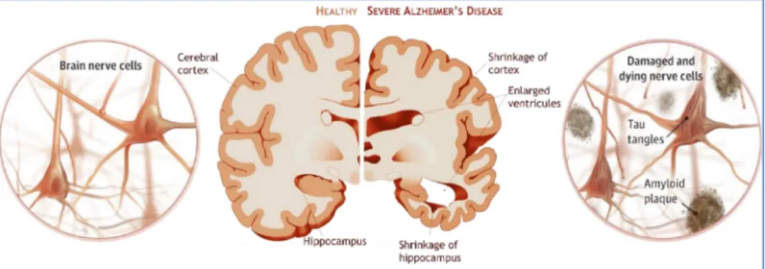 Figure 5. Changements cérébraux et neuronaux classiquement associés à la Maladie d'Alzheimer (Représentation adaptée de Jin, JAMA, 2015, 313) 44