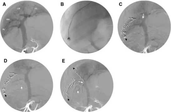 Fig. 1 A Preembolization portogram showing the portal supply to the right lateral lobe (RL), the right medial lobe (RM), the left medial lobe (LM), and the left lateral lobe (LL), and the position of the arterial catheter in the cranial mesenteric artery (