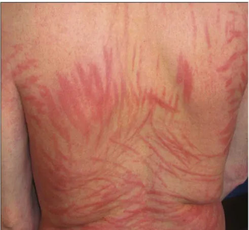 figure g9 : Photographie de dermatites fagellaires suite à la  consommation de Lentinula edodes (source : pamanetwork.com)