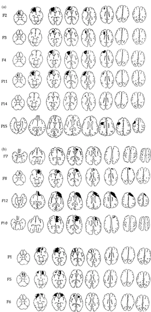 Fig. 1. Reconstruction of (a) left frontal; (b) right and bilateral frontal lesions based on CT scan and magnetic resonance scans