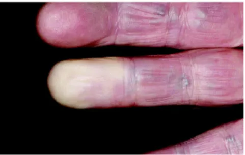 Figure 10 : Syndrome de Raynaud au niveau d’un doigt (site n°39)