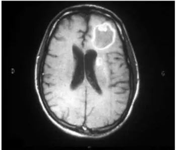 Figure 8 : Toxoplasmose cérébrale (IRM)  (13) 