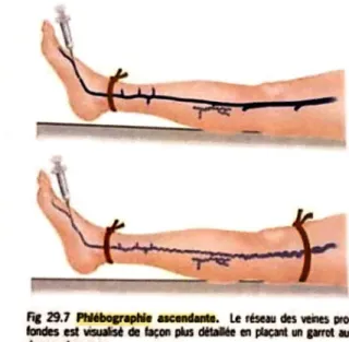 Figure 19 : Stratégie diagnostique d’une TVP (14) (27) 