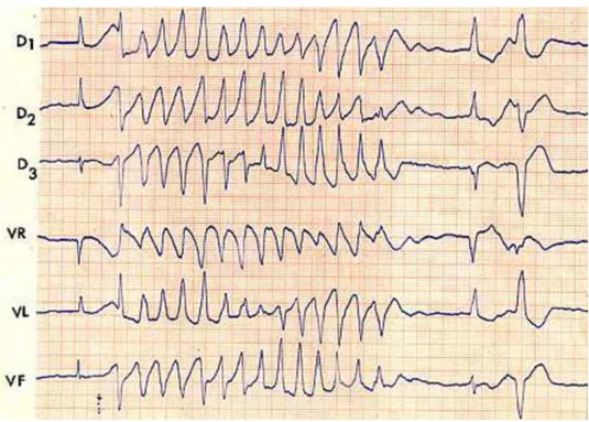 Figure 10 : Exemple de torsades de pointes sur un ECG (dérivations frontales) (22)