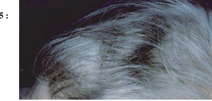 Fig. 24 et 25 : Alternance de dépigmentation et repigmentation des cheveux au cours d’un traitement  séquentiel sous Sunitinib (SUTENT®)  [ 15, 28 ]