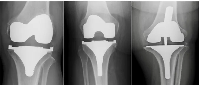 Figure 7 Radio du genou de face, PTG à glissement respectivement de gauche à droite : stan- stan-dard, avec quille d'extension tibiale, de révision