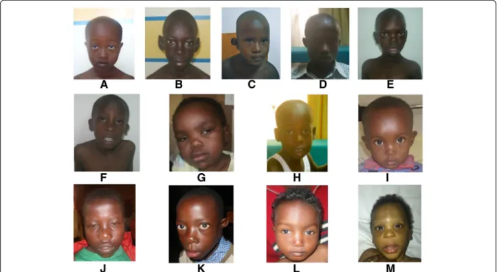 Figure 1 Pictures of the 13 patients with pathogenic CNVs. A. Patient 1 (trisomy 18p); B Patient 6 (william- Beuren syndrome); C Patient 13 (del 6q16.1q21); D Patient 14 (del 22q11.2); E patient 16 (dup 1p35.3 p31.3); F patient 17 (del 8p23.1); G patient 1