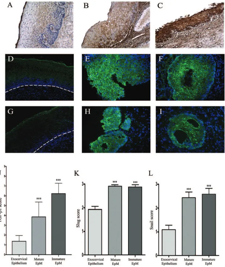 Figure 3. TGF-␤1 (A–C), Slug (D–F), and Snail (G–I) immunostaining in cervical biopsy specimens