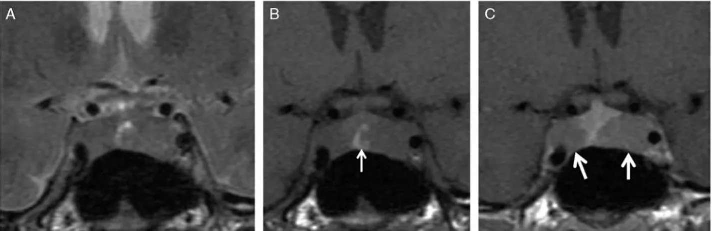 FIGURE 1. MRI at the time of diagnosis (2003). Two lesions are identified on either side of the sella turcica