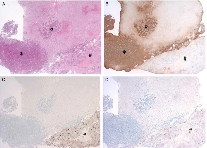 FIGURE 2. Histologic examination ( 40 magnification). A, H&amp;H stain: on the left of the image (*) strongly basophil corticotroph microadenoma