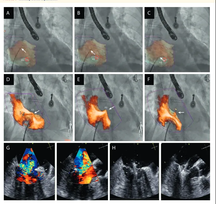 FIGURE 6 MitraClip Device Implantation