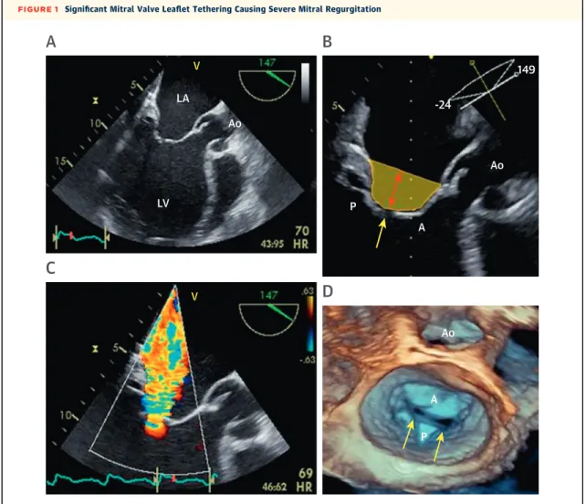 FIGURE 1 Signi ﬁ cant Mitral Valve Lea ﬂ et Tethering Causing Severe Mitral Regurgitation