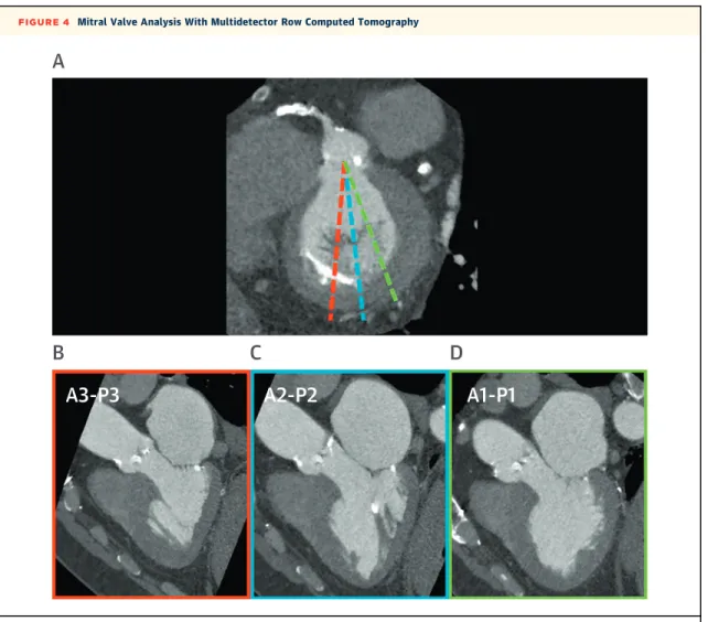 FIGURE 4 Mitral Valve Analysis With Multidetector Row Computed Tomography