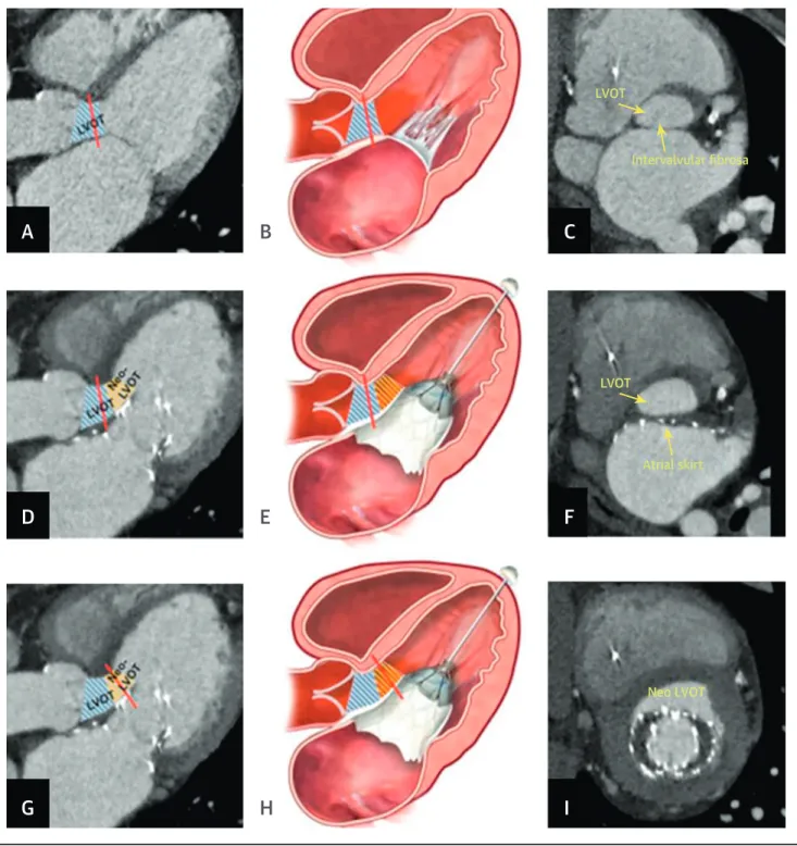 FIGURE 5 Predicting Left Ventricular Outﬂow Tract Obstruction After Transcatheter Mitral Valve Implantation
