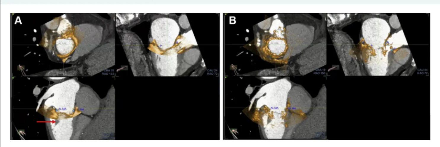 FIGURE 2 Example of Echo-CT Fusion With the Intrepid Prosthesis