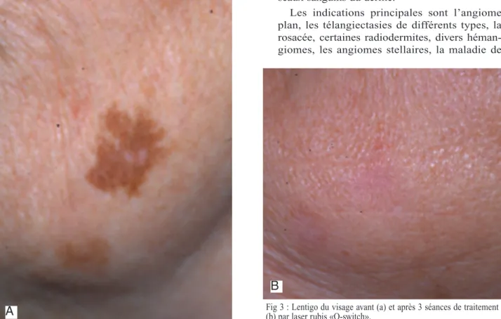 Fig 3 : Lentigo du visage avant (a) et après 3 séances de traitement (b) par laser rubis «Q-switch».