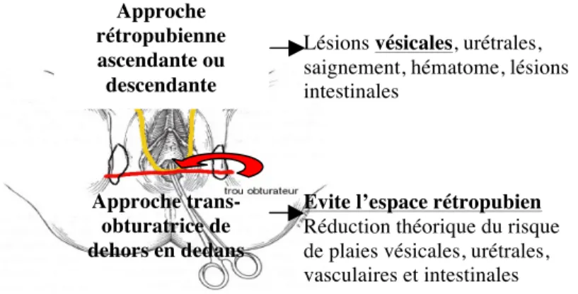 Figure  6:  Comparaison  des  bandelettes  rétropubiennes  et  transobturatrices.   L’approche  transobturatrice  vise  à  éviter  l’espace  rétropubien  qui  est  traversé  par  les  ancillaires  utilisés  pour  placer  les  bandelettes rétropubiennes