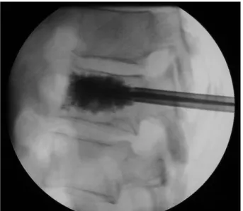 Figure 6 : Radiographie de face post-opératoire.