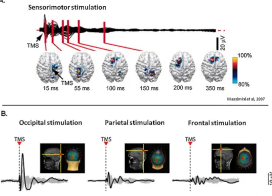Fig. 3. TMS-EEG responses in severely brain-injured patients. Response under the TMS stimulation (black trace) and the following spreading of the activity in the brain (colors represent the location of the brain areas)