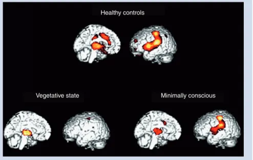 Figure 1. Cerebral activation to noxious stimulation. In red, brain regions that  activated more during noxious stimulation in healthy controls, in vegetative state and in  minimally conscious state as compared with at rest