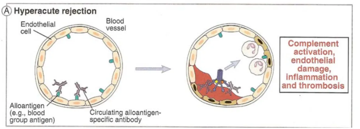 Figure 1 : Rejet hyperaigu. Tiré avec permission de Cellular and Molecular Immunology 6th  edition (2007), Abbas