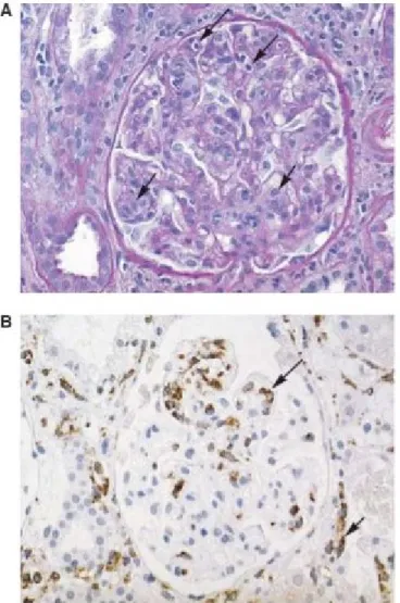 Figure 3 : Coupe histologique illustrant la glomérulite dans un capillaire. (A) Infiltration de  cellules mononuclées et gonflement des cellules endothéliales