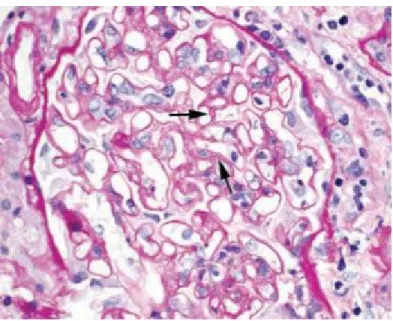 Figure 8 : Glomérulopathie du transplant chronique. Les flèches indiquent des exemples  de double-contour