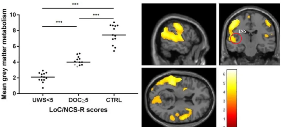 Figure  3.3.   Left:  Global  brain  metabolism  preservation  in  “FDG-PET  confirmed  unresponsive  patients (UWS)” with NCS-R score < 5, “Patients with potential pain” (i.e., patients with DoC and  an NCS-R score ≥ 5) and “Healthy controls” (CTRL; gr