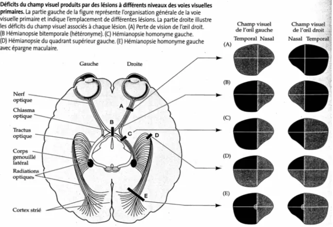 Figure 1: Déficits du champ visuel dus à des lésions des voies visuelles primaires  ( Purves et coll