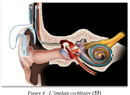 Figure 4 : L’'implant cochléaire  (55)
