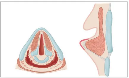 Figure 2: Cordectomie de type I ou sous-épithéliale (5)