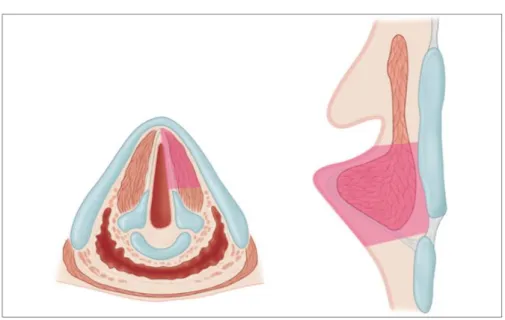 Figure 5: Cordectomie de type IV ou totale (5) 