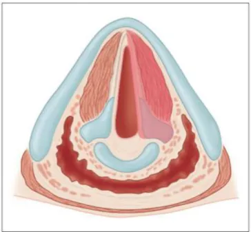 Figure 7: Cordectomie de type Vb ou étendue au cartilage aryténoïde (5) 
