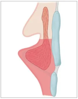 Figure 9 : Cordectomie de type Vd ou étendue à la région sous-glottique (5) 