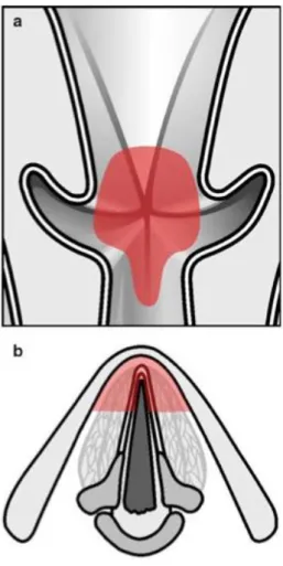 Figure 10 : Cordectomie de type VI : commissurectomie et cordectomie antérieure bilatérale (6) 