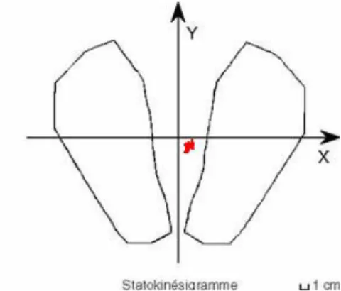 Figure  2.  Statokinésigramme*.  Hors  déficit,  les  oscillations  (en  rouge)  s'inscrivent  sur  une  surface  minime,  au  centre du polygone