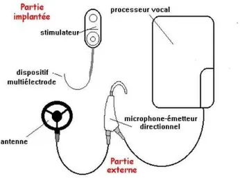 Fig 4 : Schéma de l’implant cochléaire (D’après le site www. coquelicot.com) 