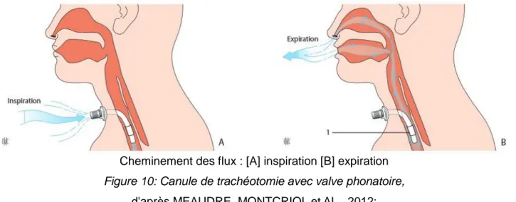 Figure 10: Canule de trachéotomie avec valve phonatoire,  d'après MEAUDRE, MONTCRIOL et AL., 2012: 
