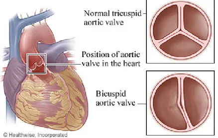 Figure 2-1 Schéma d’une valve aortique normale tricuspide et d’une valve aortique bicuspide   Tiré de : 