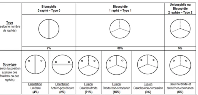 Table 2-1 Classification et prévalence des différents sous-types de bicuspidie selon Sievers &amp; 