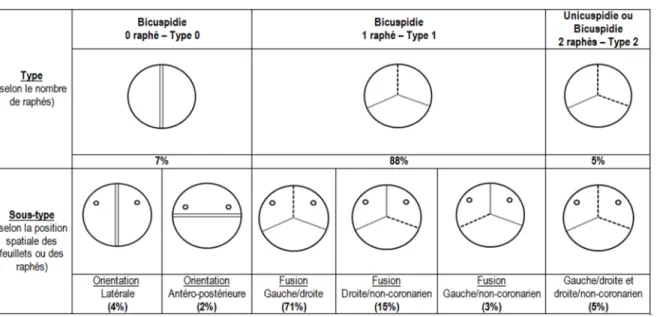 Table 2-1 Classification et prévalence des différents sous-types de bicuspidie selon Sievers &amp; 