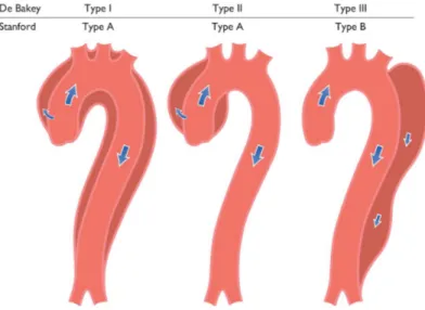 Figure 2-6 Classification des dissections aortiques  